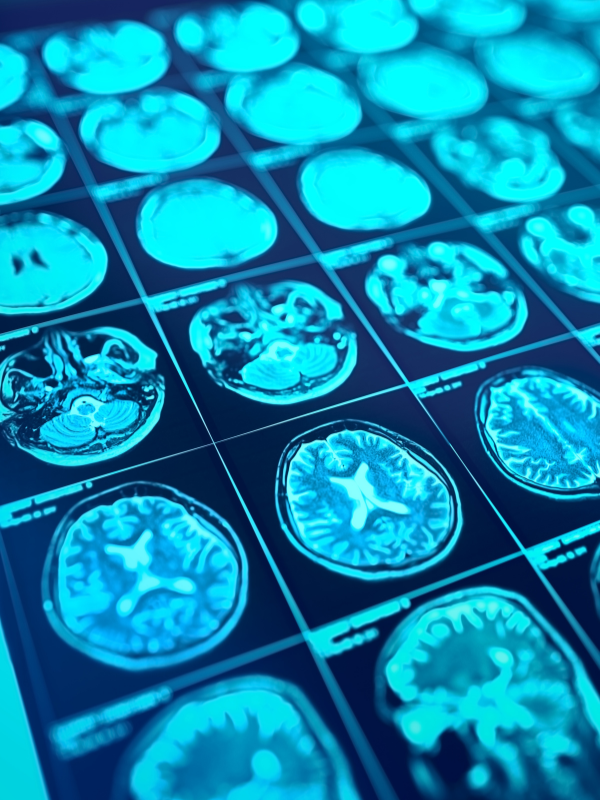PET Scan