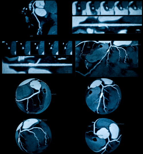 Angiography Tests