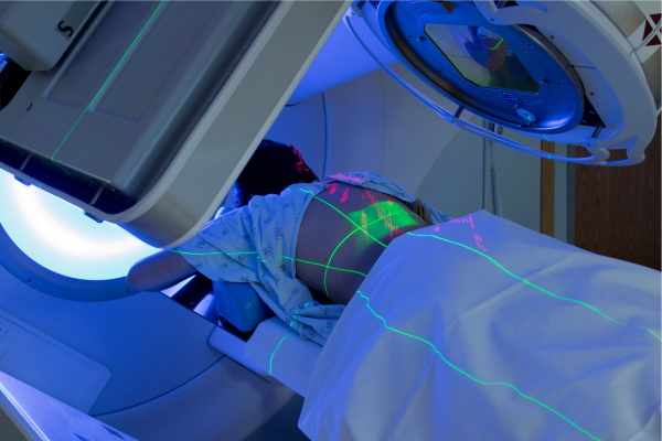 Radiation Therapy