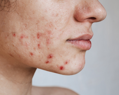 Acne & Scar Removal Treatments Services